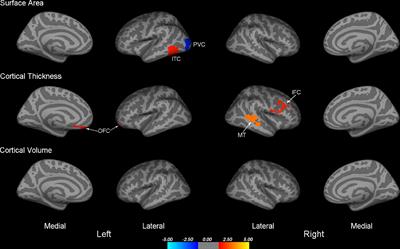 Abnormal cortical morphology in children and adolescents with intermittent exotropia